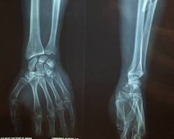 Imagen de Radiografía de una fractura de hueso